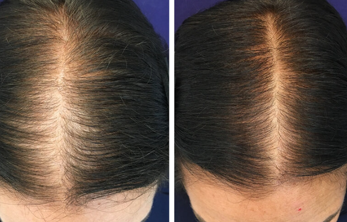 Restore Skincare- At home Microneedling Kit for Hair