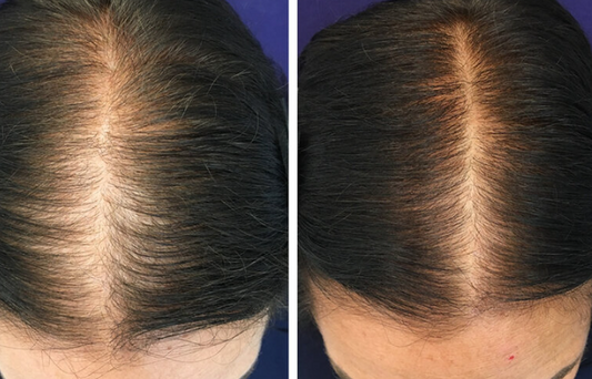 Restore Skincare- At home Microneedling Kit for Hair