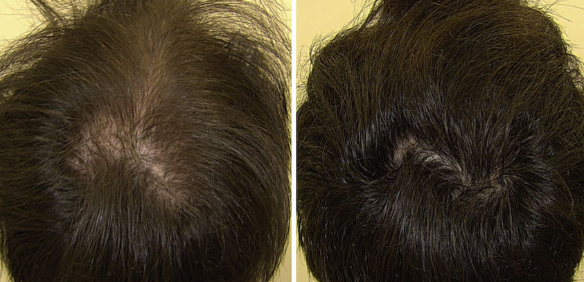 Restore Skincare- At home Microneedling Kit for Hair